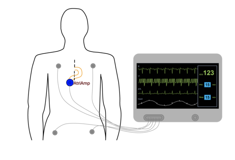 Display of the Surface and Atrial Electrogram – Atrial Electrogram ...