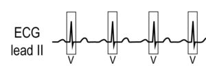 Display of the Surface and Atrial Electrogram – Atrial Electrogram ...