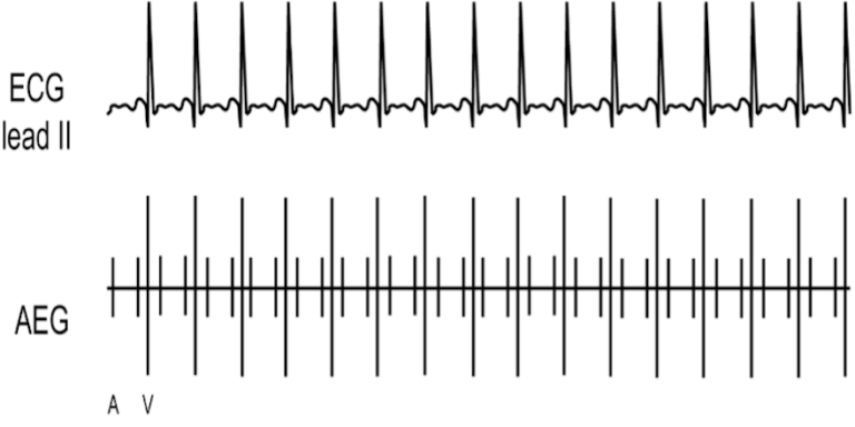 Intra-Atrial Reentrant Tachycardia (IART) – Atrial Electrogram ...