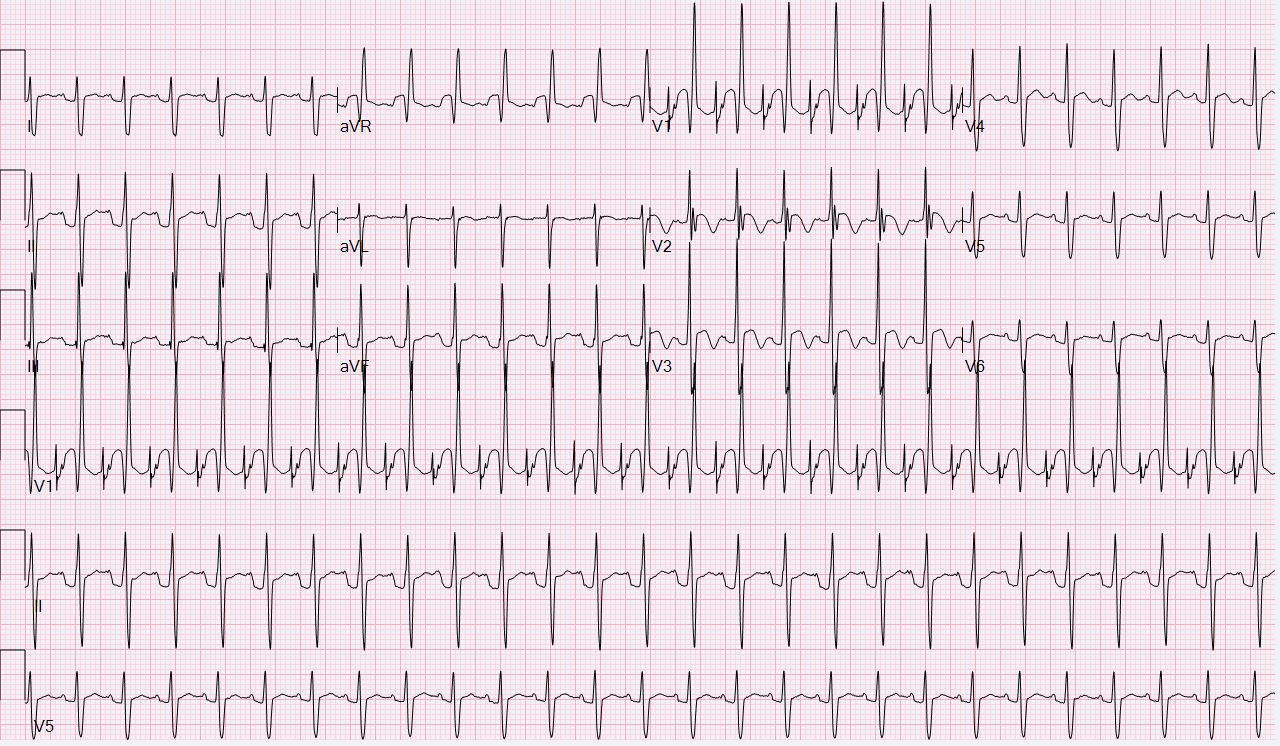Display of the Surface and Atrial Electrogram – Atrial Electrogram ...